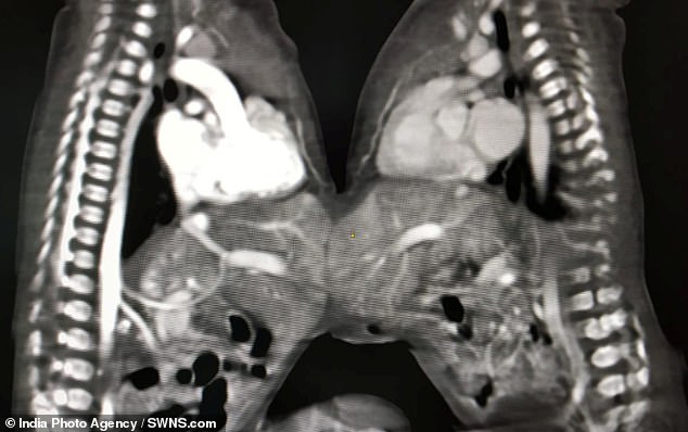Births of conjoined twins, whose skin and internal organs are fused together, are rare. They are believed to occur just once in every 200,000 live births (pictured, another scans shows how the twins were joined together at the stomach)