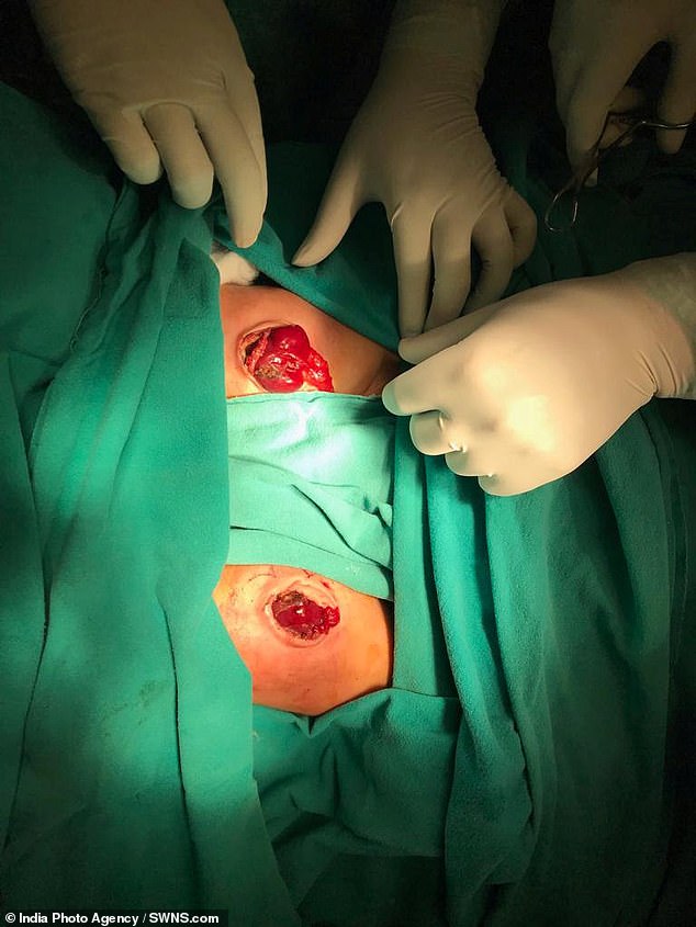 The operation took place on December 6 and was performed by a team of five surgeons, ten doctors and 15 nurses (pictured, the stomachs of the baby girls after the surgery)