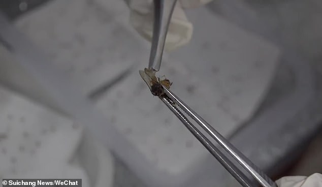 After undergoing an hour-long emergency procedure, the farmer is said to have been in stable condition. The picture released by Suichang News shows a bee removed from Ms Huang