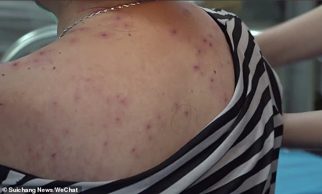A Chinese woman in Zhejiang province, has had over 400 bee¿s stingers removed from her body after the farmer was attacked by an army of the flying insects whilst working on a field