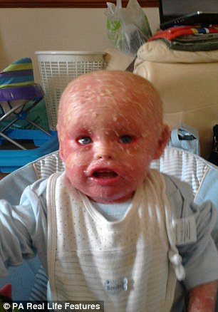 Harlequin ichthyosis is incurable, and parents have to apply ointment to Jayden