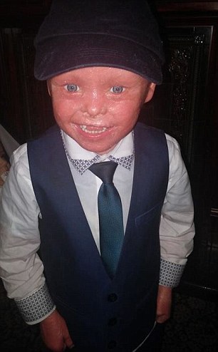 Jayden Watson, five, was born with rare genetic condition harlequin ichthyosis, which means his skin grows seven times faster than normal